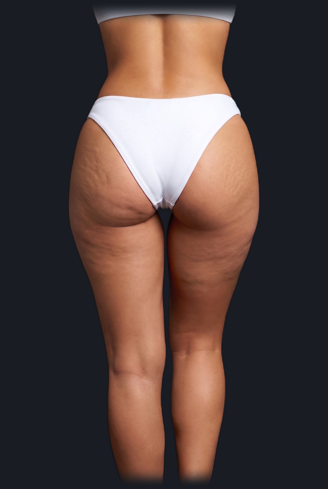 Antes: celulitis fibrosa (imagen ilustrativa)
